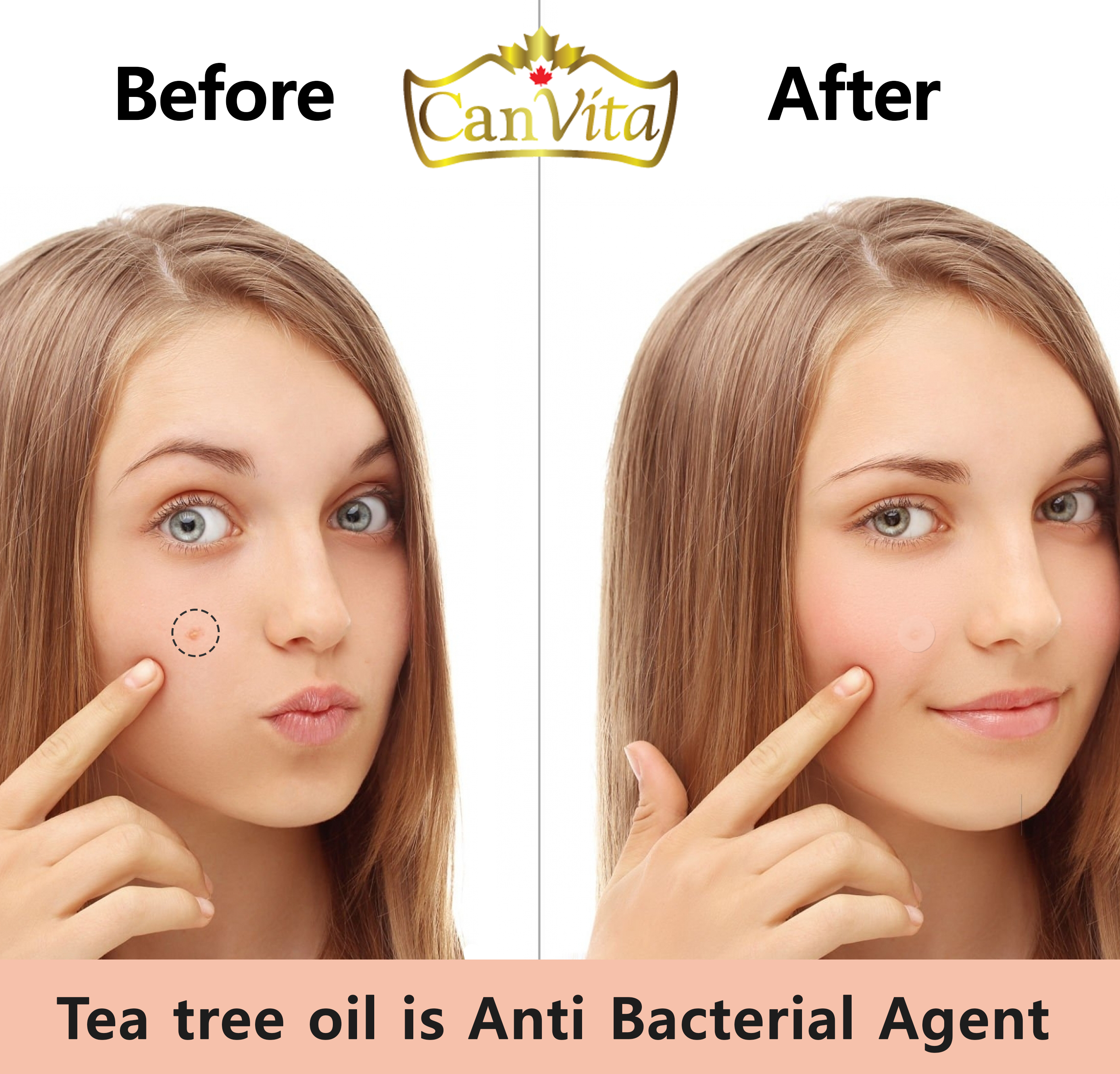 CanVita Pimple Patches - 72 Dots of Effective Solution for Skin Care - Canvita