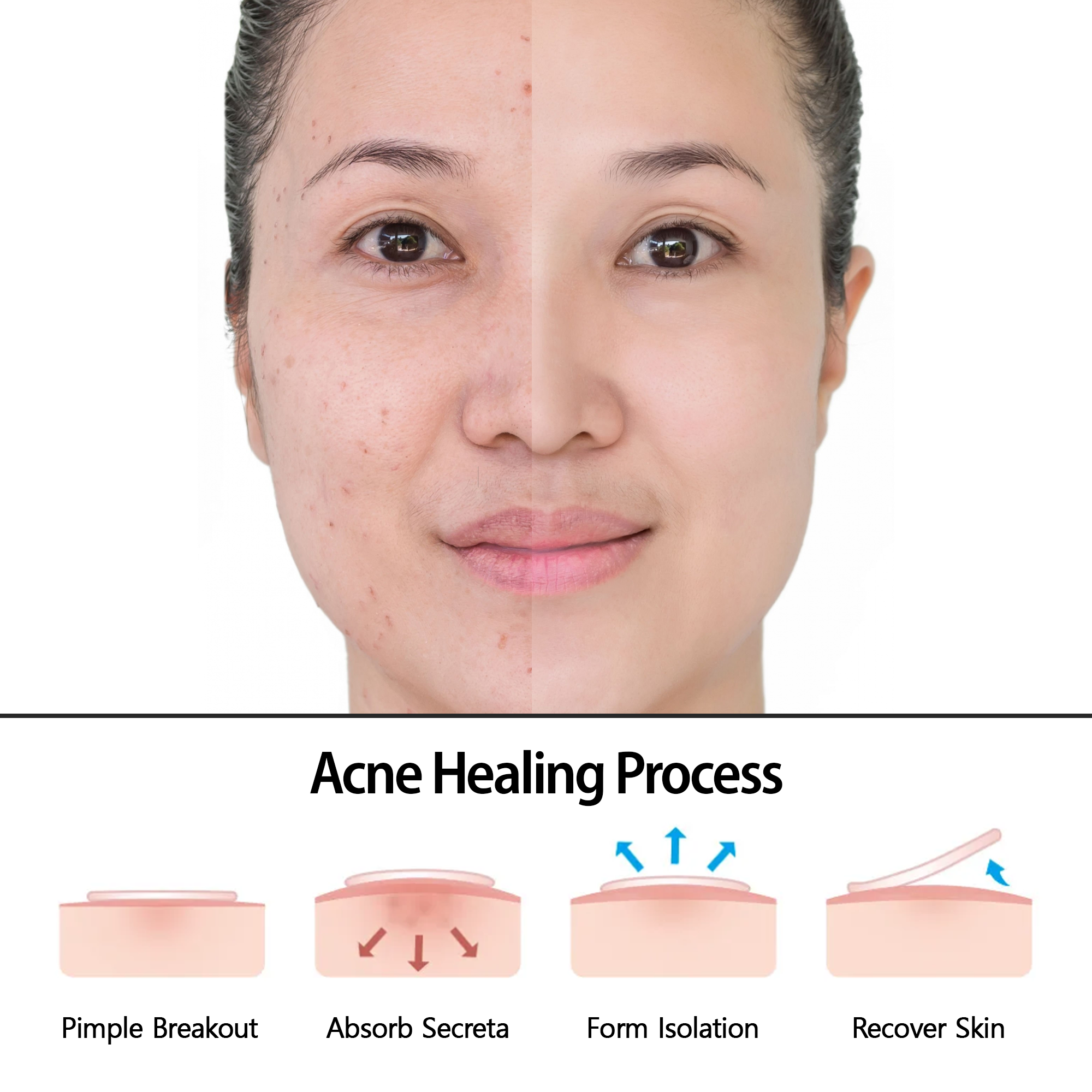 CanVita Pimple Patches - 72 Dots of Effective Solution for Skin Care - Canvita